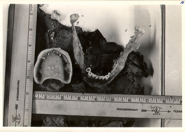 The jaw and dentures of a woman in her 50s whose body parts were found in the Willamette River in 1946. Her identity and murderer have never been found. (Courtesy photo) 