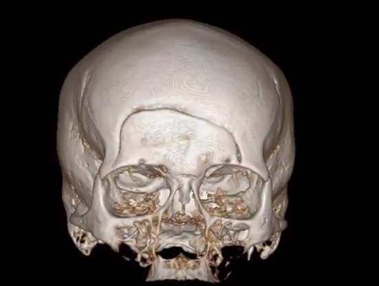 A CT scan of the skull of Unidentified Person 9457 shows a distinctive cranial scar The body of this woman was found September 1, 1996 in Polk County. She has never been identified. November 16, 2017 (Courtesy: OSP Medical Examiner Division)