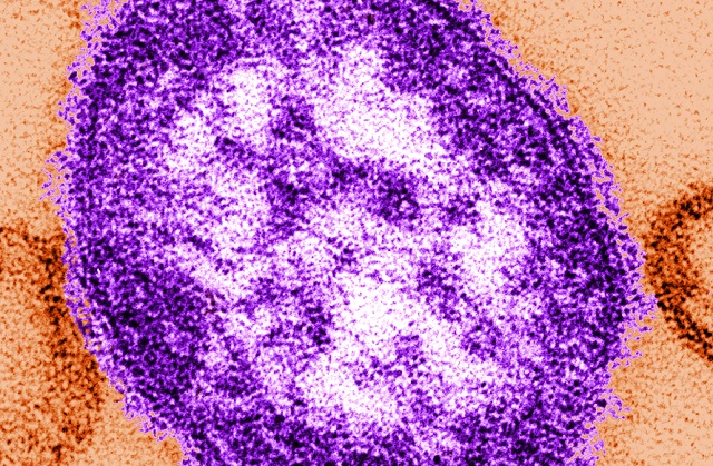 Measles_175886