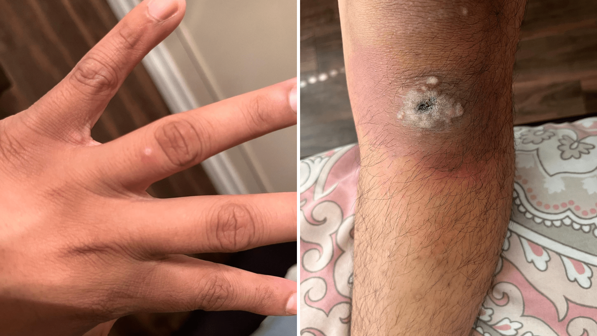 Oregon man's monkeypox test results delayed as virus continues to spread