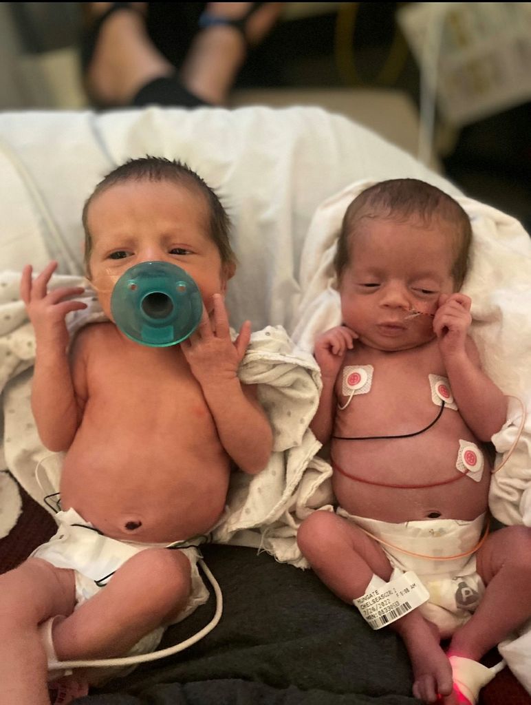 Twin girls survive pregnancy thanks to OHSU's fetal surgeons